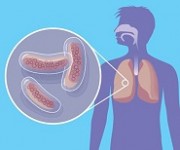 Актуальные вопросы профилактики и лечения туберкулеза у детей и подростков обсудят на конференции в Сочи