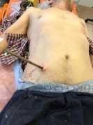 Кубанские хирурги спасли пациента, упавшего на арматуру