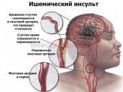 В неврологическом отделении Регионального сосудистого центра горбольницы Новороссийска спасли пациента с ишемическим инсультом В неврологическом отделении Регионального сосудистого центра горбольницы Новороссийска спасли пациента с ишемическим инсультом